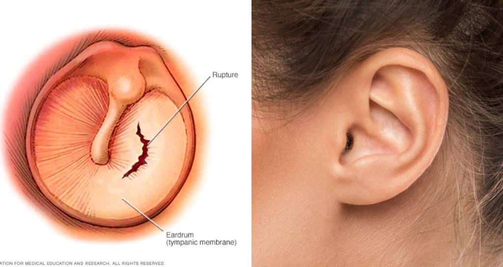 Kulak Zarı Delinmesi Nasıl Olur?